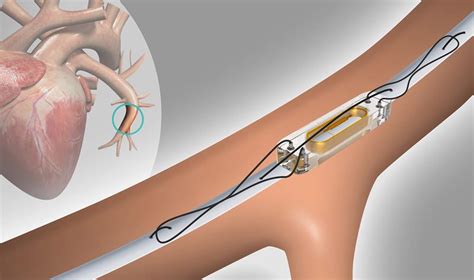 CardioMEMS™ Implant - Center for Advanced Cardiac and Vascular ...