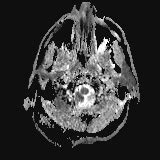 File:Cerebellar, hippocampal, and basal nuclei transient edema with ...