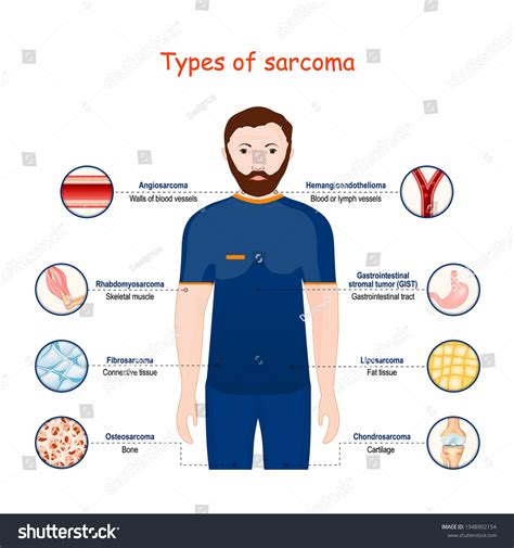 Sarcoma Types Malignant Tumor Cancer That Stock Vector (Royalty Free) 1948902154 | Shutterstock