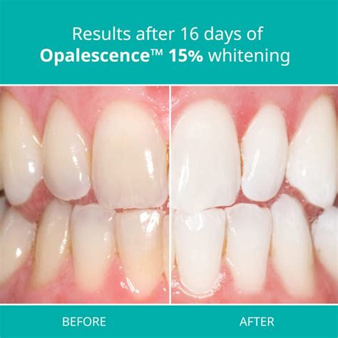 Opalescence 15% Instructions: How to Apply the Gel and Commonly Asked ...