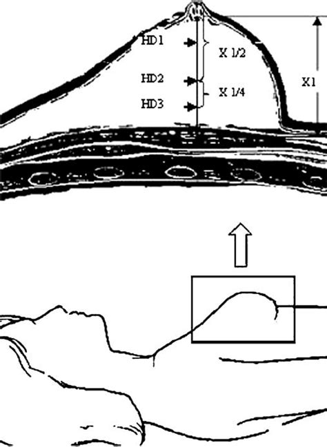 The schematic illustration of breast thickness and Hounsfield density.... | Download Scientific ...