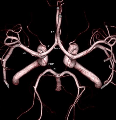 Circle Of Willis Variant Anatomy