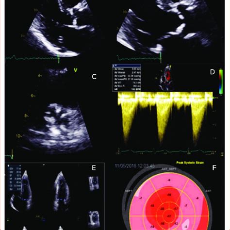 (PDF) Moderate Aortic Stenosis: What is it and When Should We Intervene?