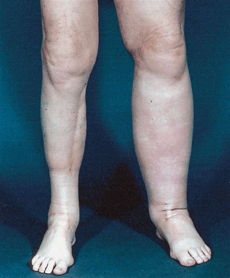 The multiple causes of Swollen Legs – DrStaicu.com