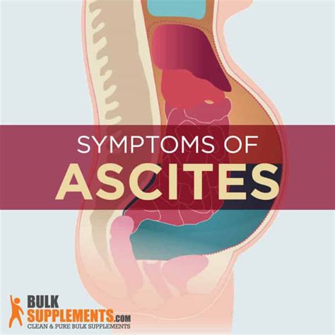 Ascites: Symptoms, Causes & Treatment