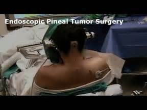 Pineal Gland Cyst Surgery Recovery | Gallery Demax