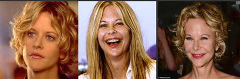 Meg Ryan Plastic Surgery Before and After Facelift and Botox - Star ...