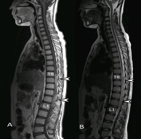 Cureus | Glioblastoma Multiforme Involving Conus Medullaris in a Child