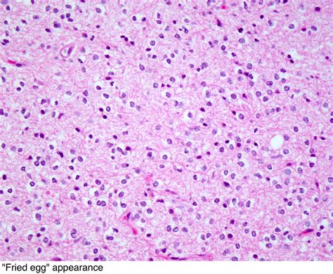 Pathology Outlines - Oligodendroglioma, IDH mutant and 1p/19q codeleted