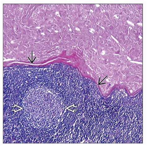 Branchial Cleft Cyst Histology