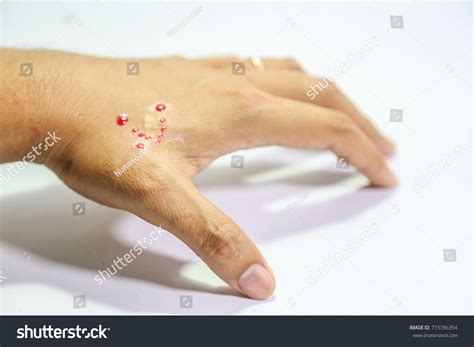 Wound Snake Bite Lesion Blood On Stock Photo (Edit Now) 715786354