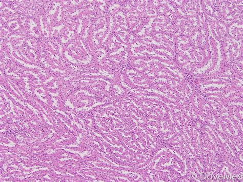 Mucinous Tubular and Spindle Cell Carcinoma of Kidney