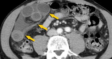 The Radiology Assistant : Closed Loop Obstruction in Small bowel obstruction