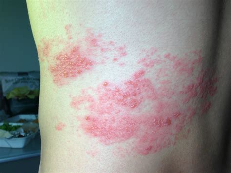 The Early Stages Of Shingles Signs And Symptoms - vrogue.co
