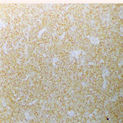 Lymph node biopsy: Immunohistochemical stain of lymph node shows ...