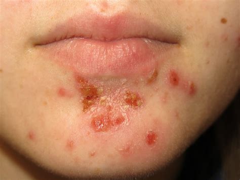 Today's Pearl, Impetigo | Impetigo, Home remedies, Remedies