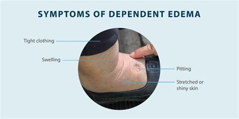 Dependent Edema: Symptoms, Causes, Treatment & More - Tactile Medical