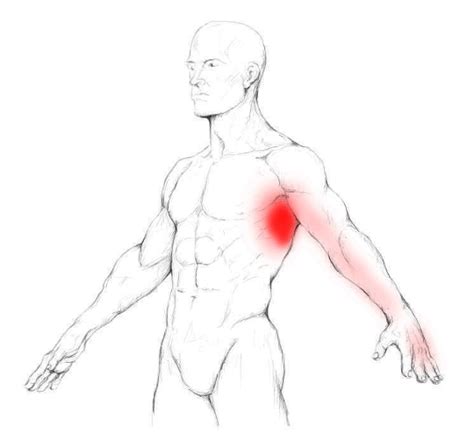 Serratus anterior muscle pain & trigger points