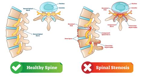 Cervical Spinal Stenosis Treatment, Symptoms & Causes| QI Spine