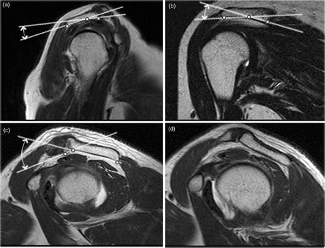 Acromion Types