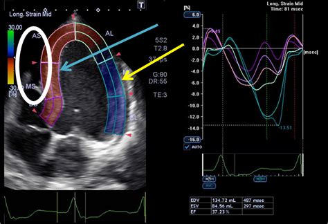 Dr. Smith's ECG Blog: LBBB on Cardiac Ultrasound: do not be fooled into diagnosing a wall motion ...