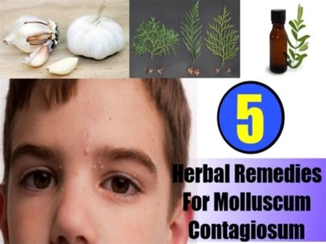 5 Best Herbal Remedies For Molluscum Contagiosum