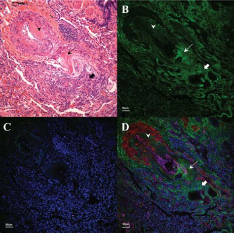 HA in a plexogenic IPAH lesion. Tissues were stained similar to Fig. 3 ...