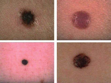 nodular melanoma size - pictures, photos