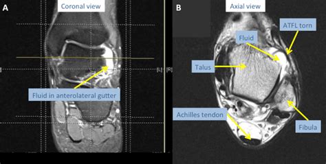 Medial Ankle Ligaments Mri