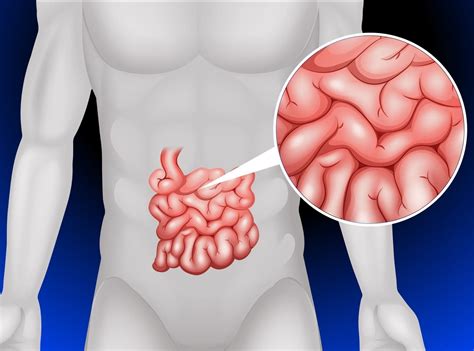 Meckel's Diverticulum - familydoctor.org