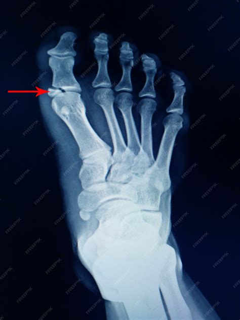 Premium Photo | X-ray of foot fracture