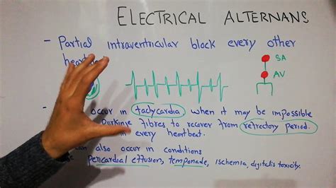 Electrical Alternans