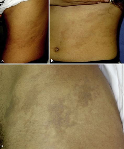 Ashy dermatosis causes, symptoms, diagnosis & treatment