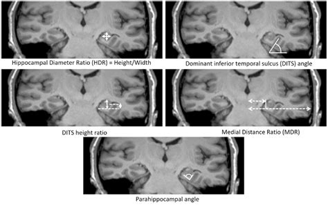 Brain Sciences | Free Full-Text | Hippocampal Malrotation: A Genetic Developmental Anomaly ...