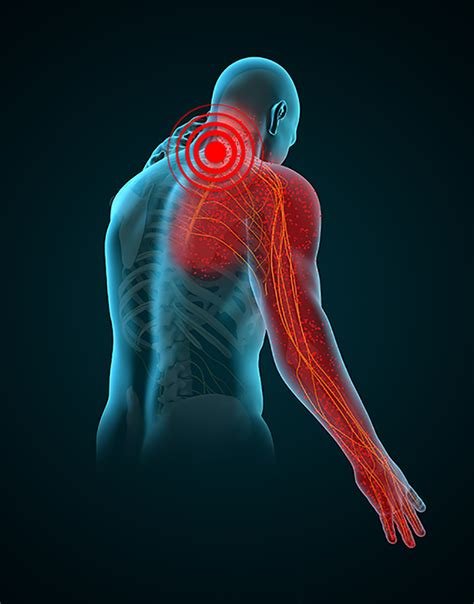 Radiculopathy Surgery in NJ and NYC