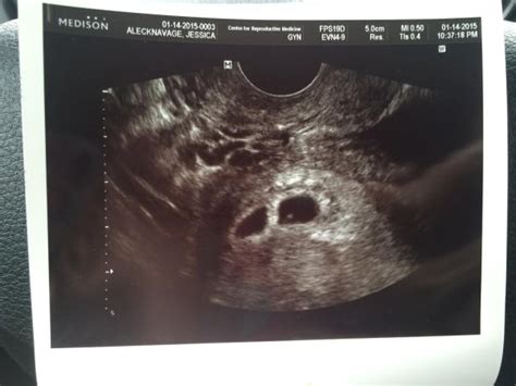 First Ultrasound at 5 weeks, maybe twins! - BabyCenter