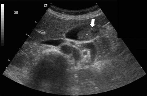 Gallbladder Ultrasound Sludge