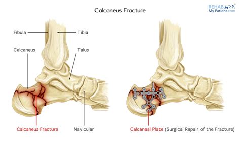 Calcaneus Fracture | Rehab My Patient