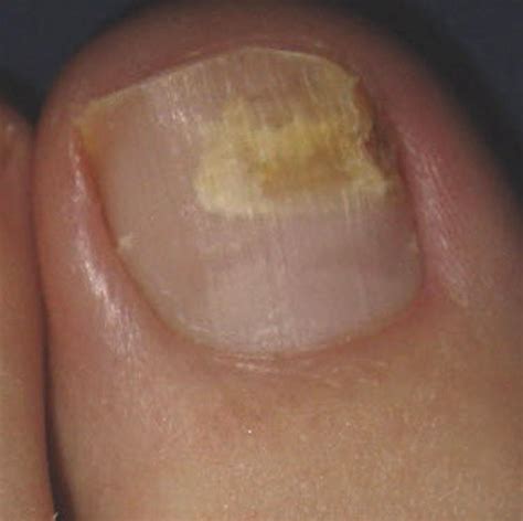 Toe Nail Fungus - Top 10 Make Up Cosmetics