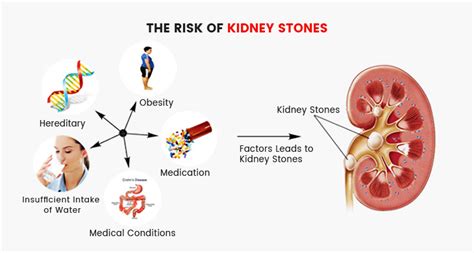 Kidney Stones: Ouch! Causes, Symptoms, Treatment - Knoxville Hospital ...