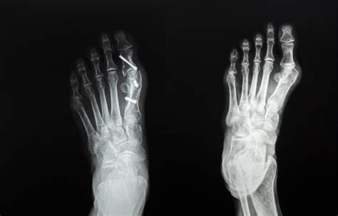 Bunion Surgery Screws