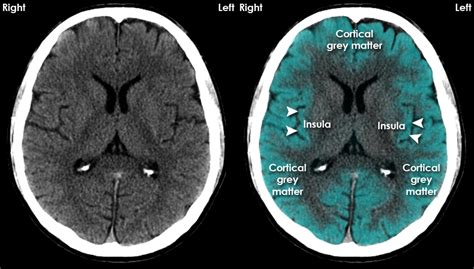 Ujjwal Upadhyay - Brain Anatomy using CT Scans