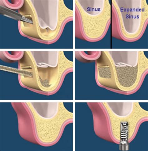 Sinüs Lifting Nedir? - Nilüfer Diş Kliniği - İmplant