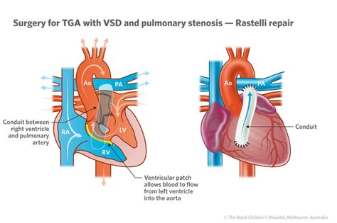 Cardiology : Transposition of the Great Arteries with VSD and Pulmonary ...