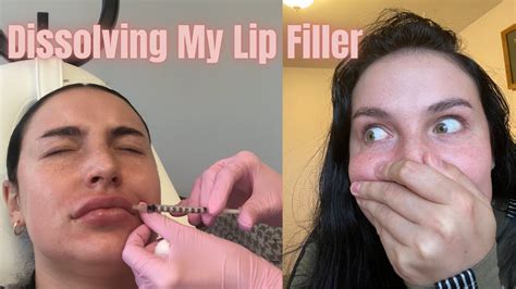 Dissolving Lip Fillers (Before and after with hyaluronidase) Vlog pt. 1 ...