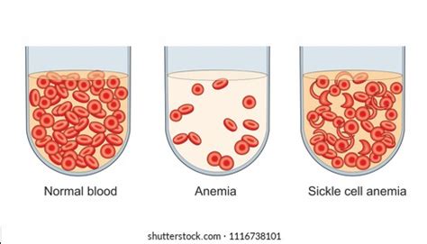 940 Sickle Cell Anemia Images, Stock Photos, 3D objects, & Vectors | Shutterstock