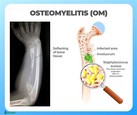 How To Diagnose Osteomyelitis - Intelligencesupply16