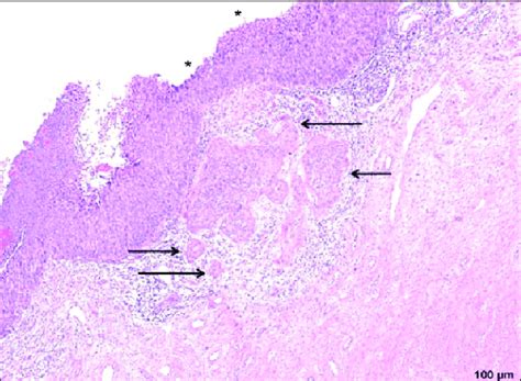 Squamous Cell Carcinoma Histology Labeled | The Best Porn Website