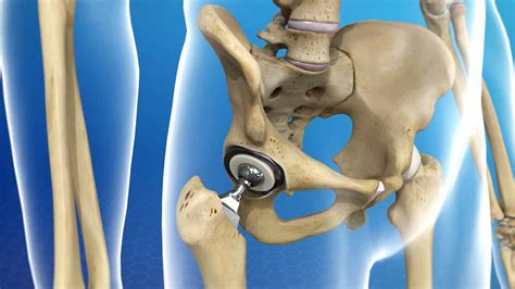 Hip Replacement Surgery In Indonesia, Hip Replacement Surgery Hospital Cost In India For ...