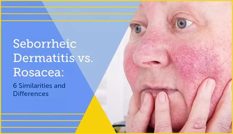 Seborrheic Dermatitis vs. Rosacea: 6 Similarities and Differences ...